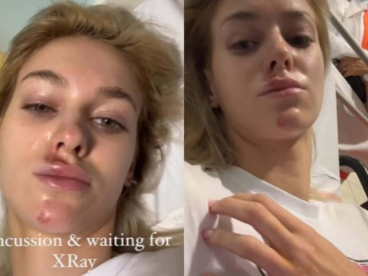 Tom Brady’s rumored girlfriend Veronika Rajek gets badly injured on her Italy trip as she shares SHOCKING pictures of her bruised face from hospital