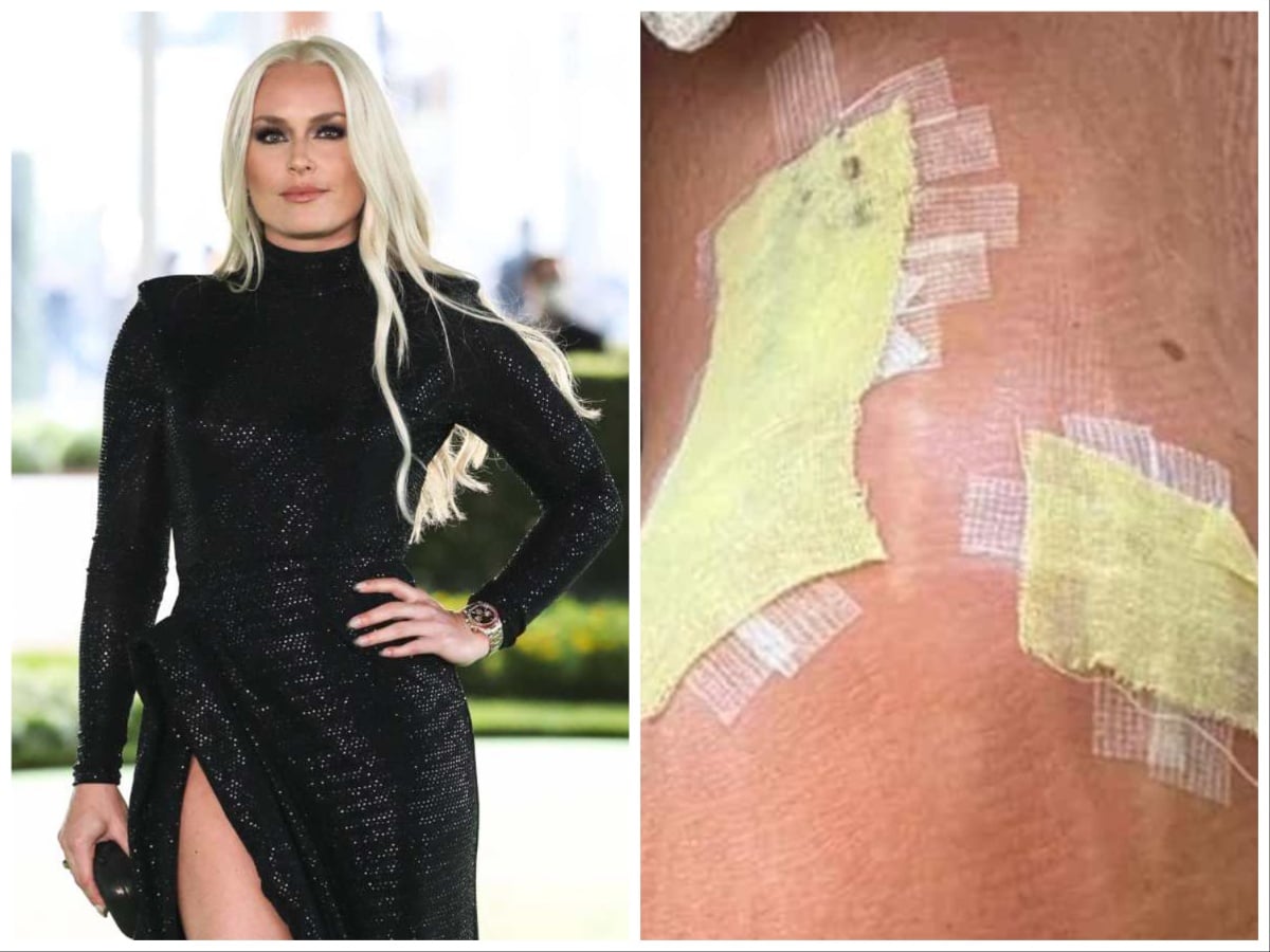 Ski queen Lindsey Vonn confirms preparation for undergoing knee replacement surgery in latest post