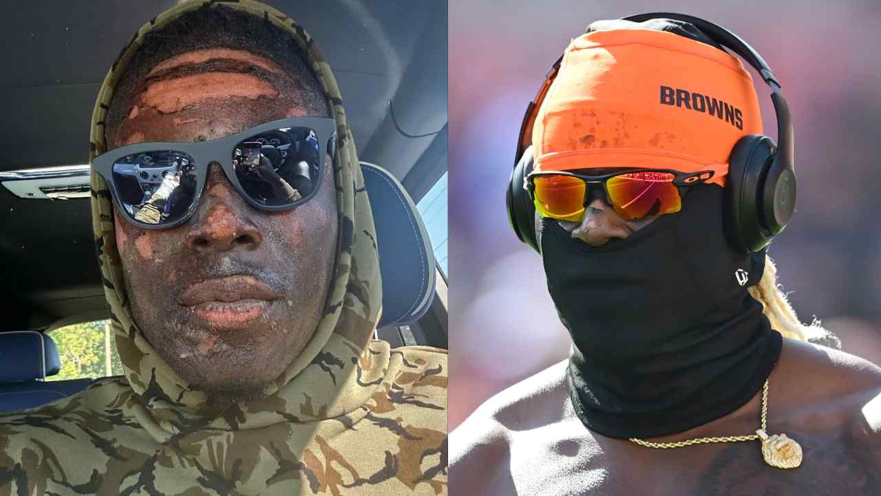 “Next level toughness!” – David Njoku sharing ‘disturbing’ pictures of his burnt face after fire pit accident leaves NFL fans in shock