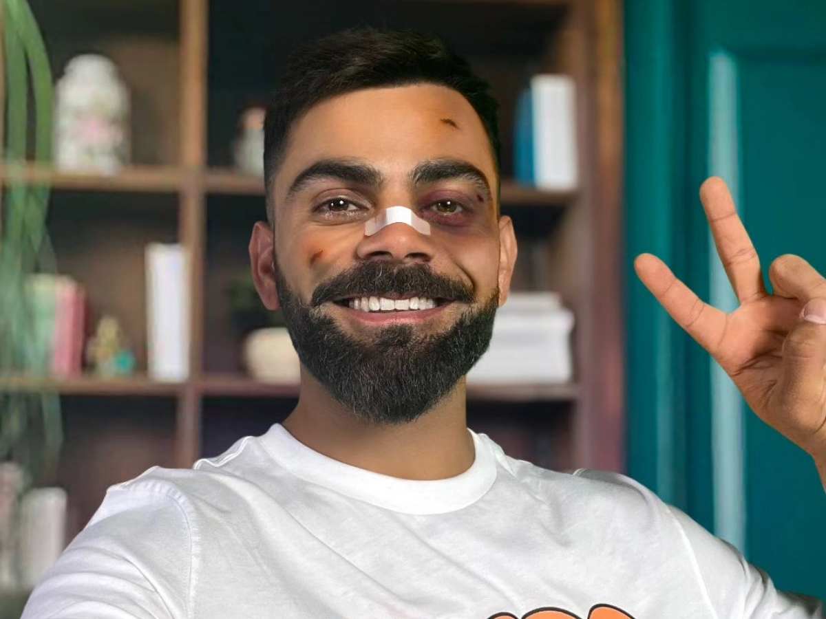 Virat Kohli posts a picture of himself with bruises, but are they real? 