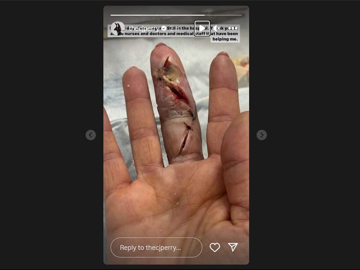 CJ Perry's infected finger