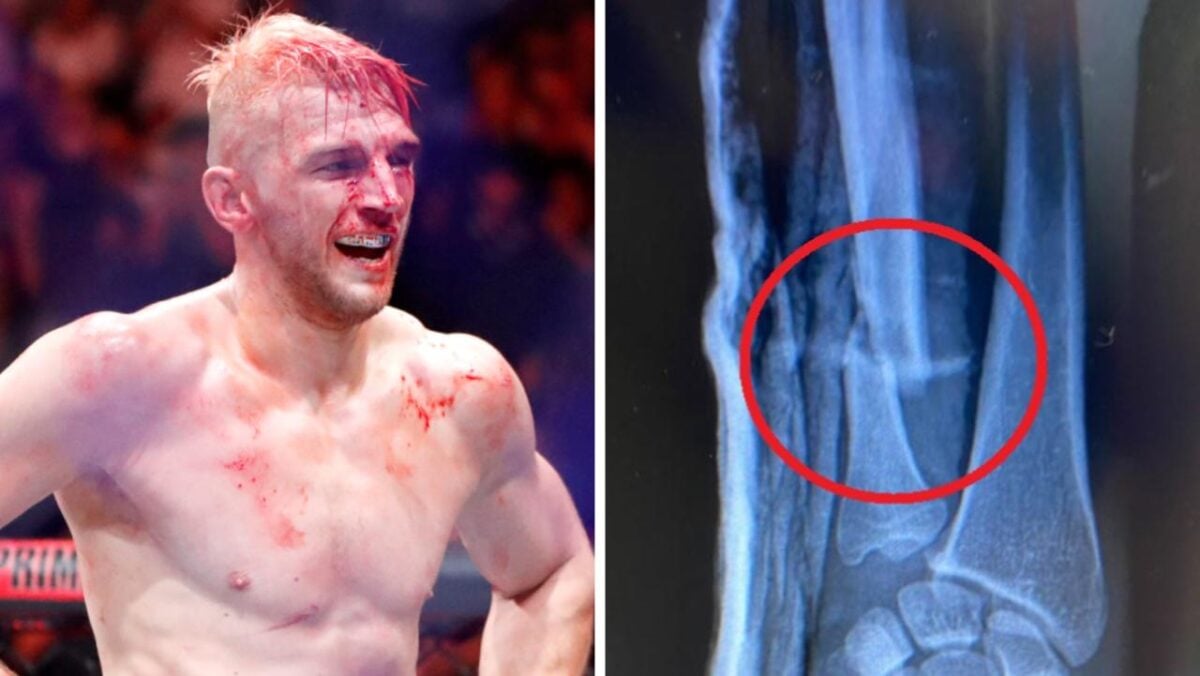 Dan Hooker's broken arm injected with bone marrow 