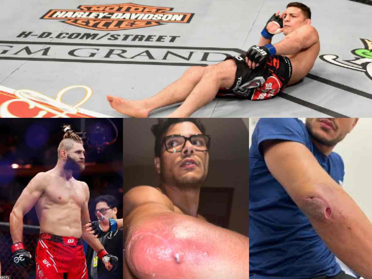 In all probability, Nick Diaz joins a long list of fighters victimized by staph infection