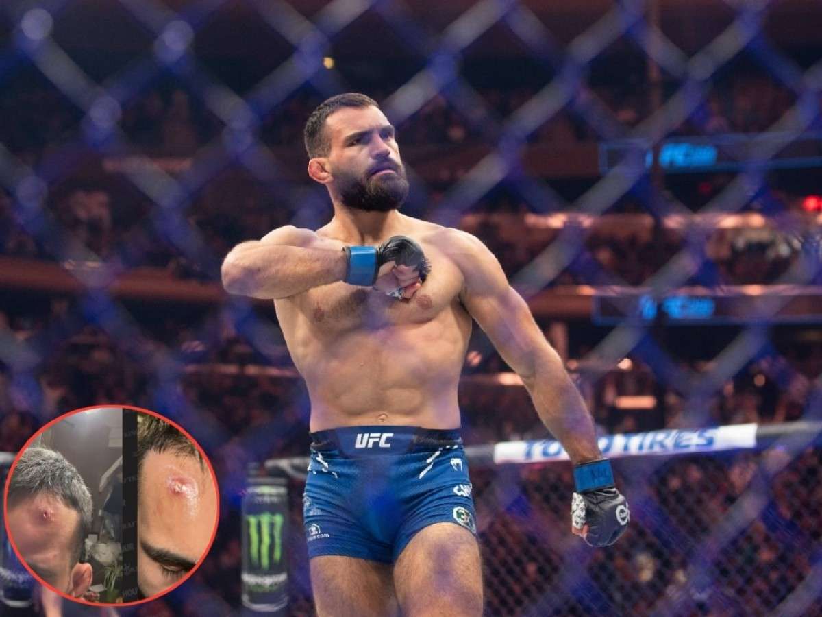 Graphic Warning! Benoit Saint-Denis shares GRUESOME staph infection photos leading up to UFC 299 loss