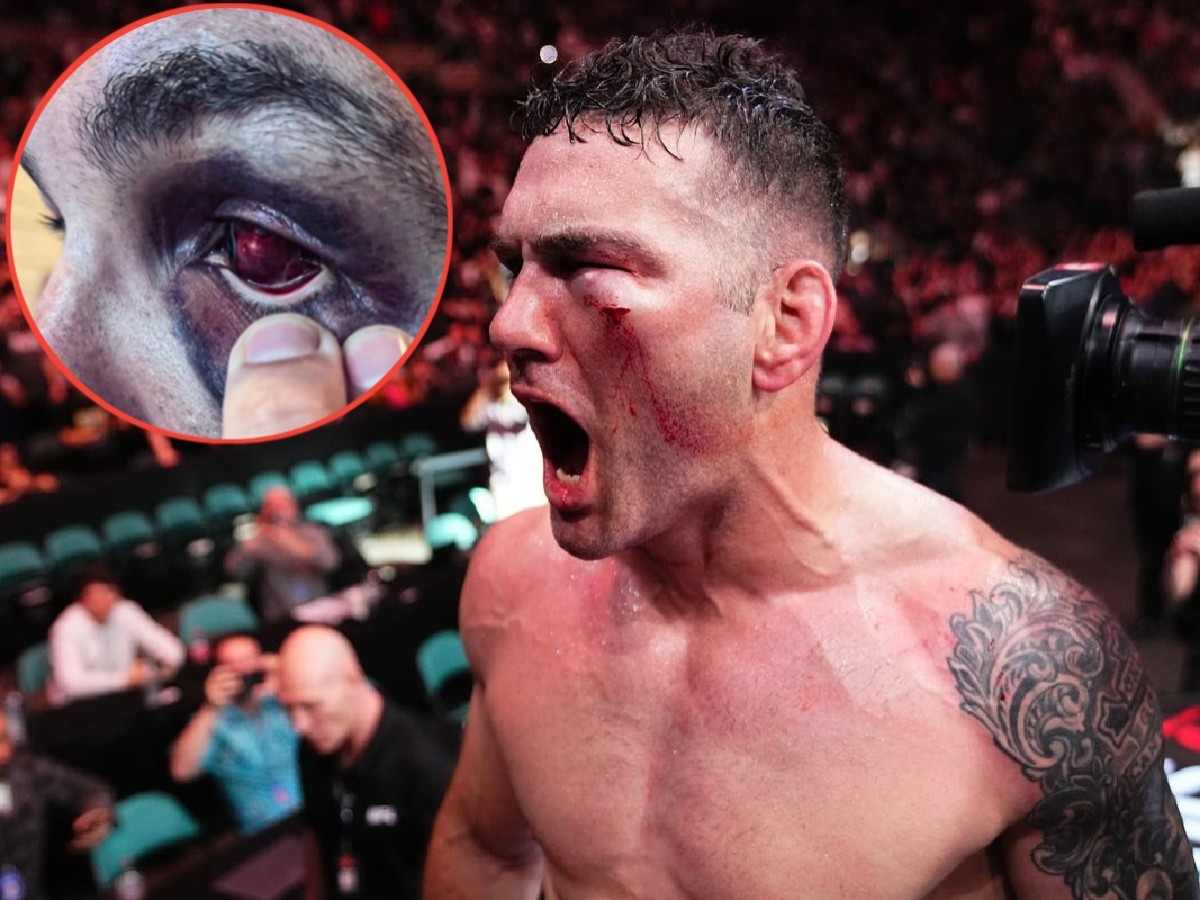 Graphic Warning! Chris Weidman shares brutal image of eye after UFC Atlantic City leaving fans in shock