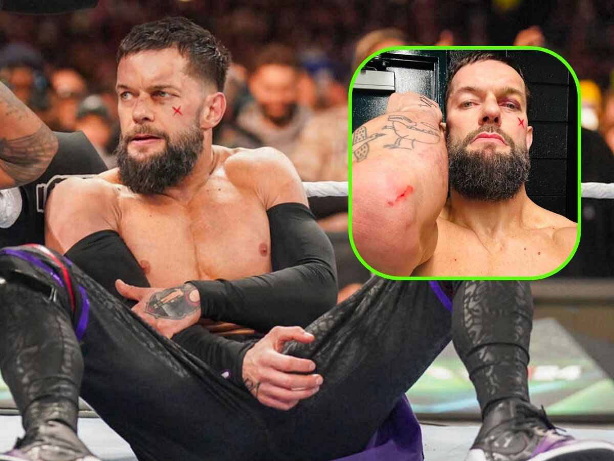 Finn Balor shows off nasty battle scars injury after WrestleMania XL, compares it with getting 14 staples last year