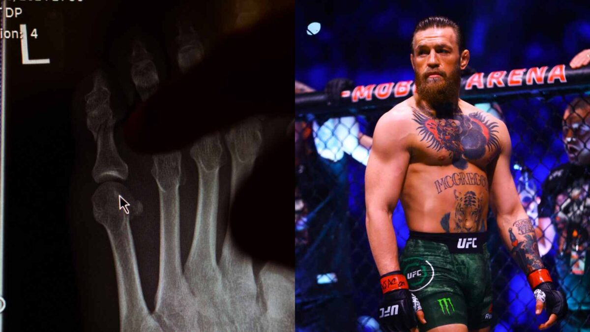 Conor McGregor puts end to 'substance abuse' rumors by revealing pictures of toe injury ahead of ...